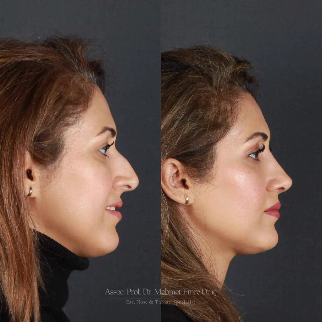 rhinoplasty turkey