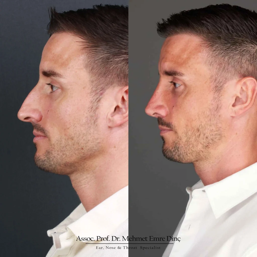rhinoplasty istanbul
