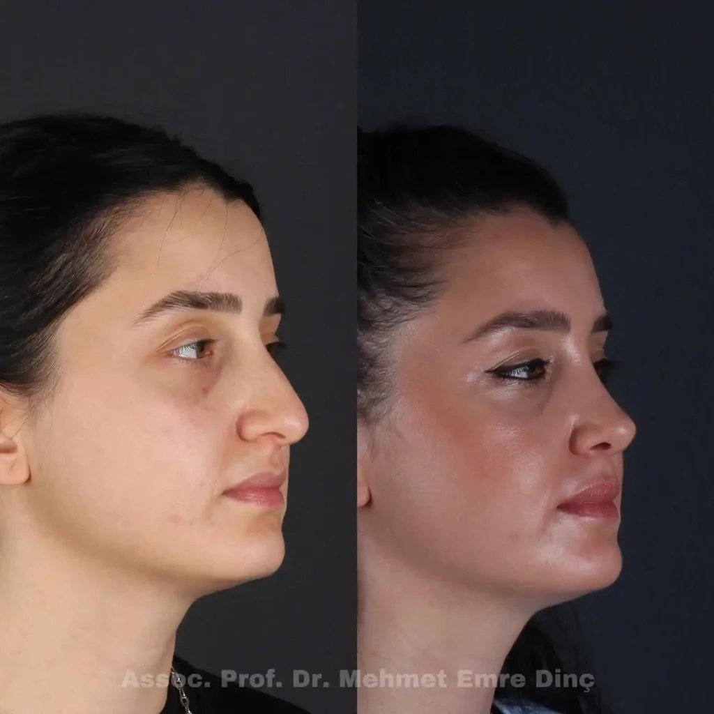 Rhinoplasty Turkey