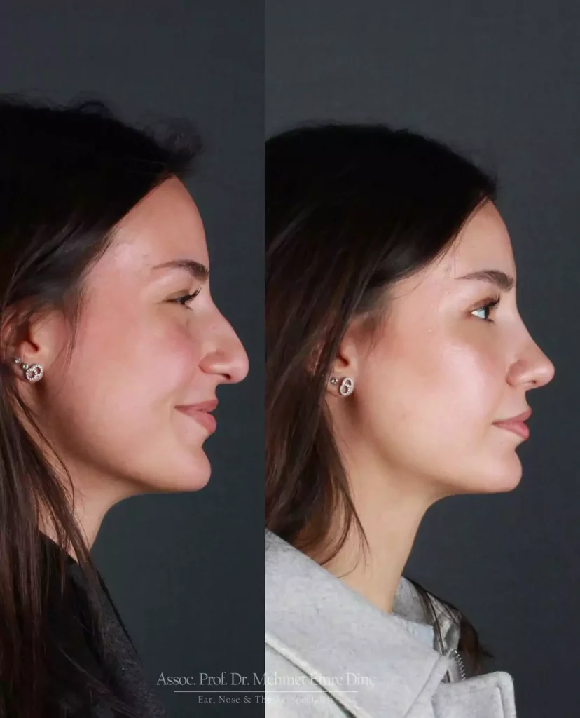 Burun Estetiği 3 burun estetiği sonrası 8. ay